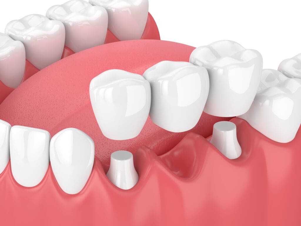 Dental bridges in Carol Stream & Elgin IL
