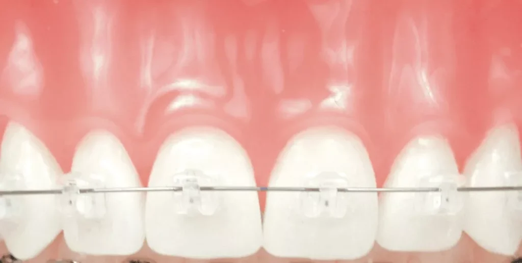 Damon braces in Carol Stream & Elgin Illinois