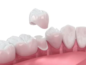 So You Need a Dental Crown? What to Know in Carol Stream, IL